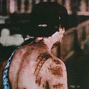 A victim of Hiroshima